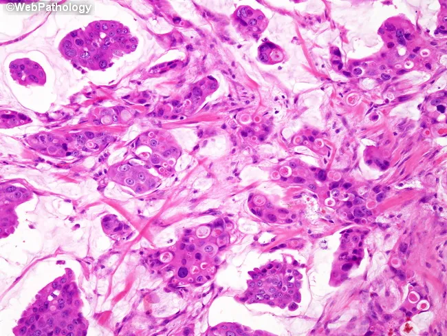 Mucinous Carcinoma of Breast