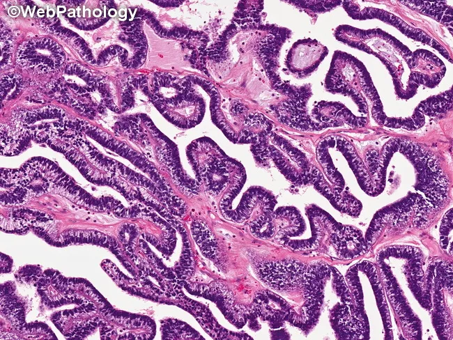 Yolk Sac Tumor : Glandular Pattern