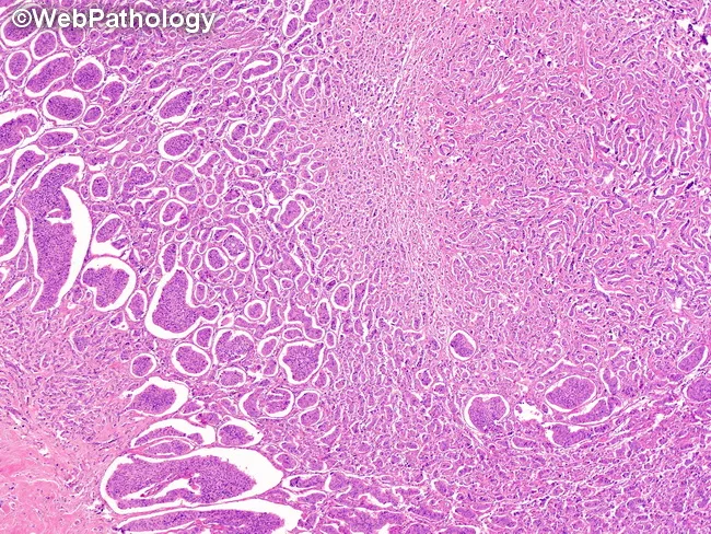 Ovarian Carcinoid : Mixed Pattern