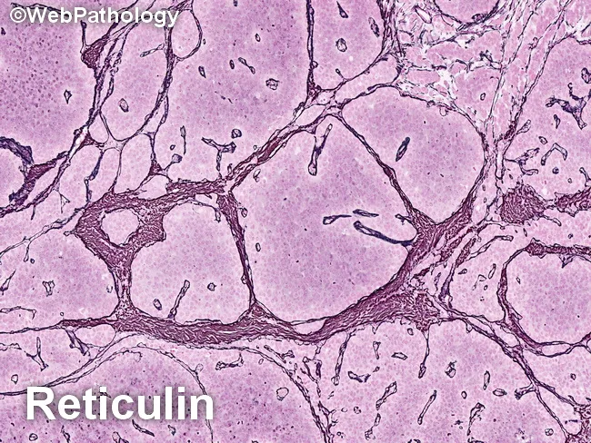 Adult Granulosa Cell Tumor : Reticulin