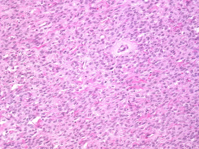 Fibrosarcoma of the Ovary
