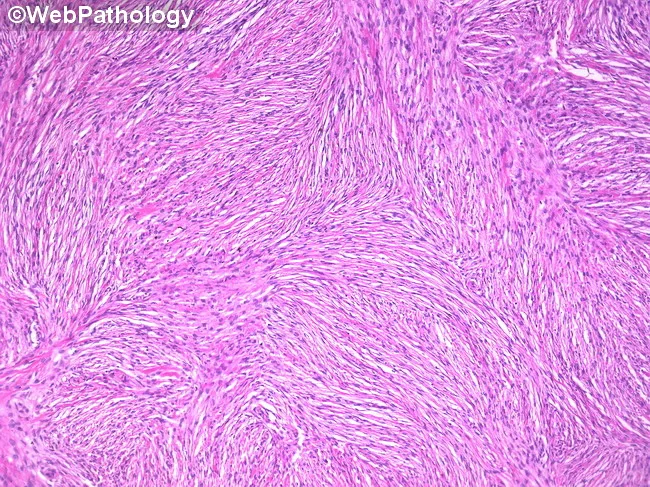 Ovarian Fibroma : Microscopic Features