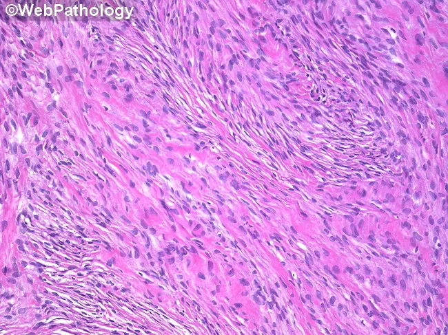 Ovarian Fibroma : Microscopic Features