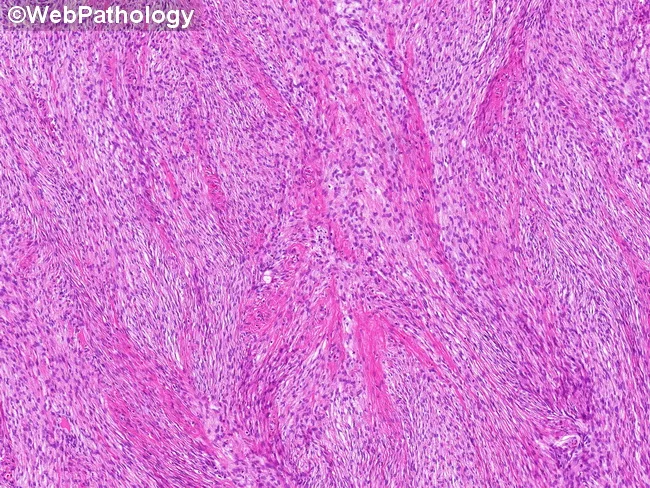 Ovarian Fibroma : Microscopic Features
