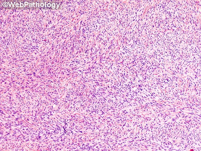 Ovarian Fibroma : Differential Diagnosis