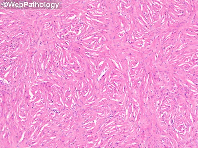 Ovarian Fibroma : Differential Diagnosis