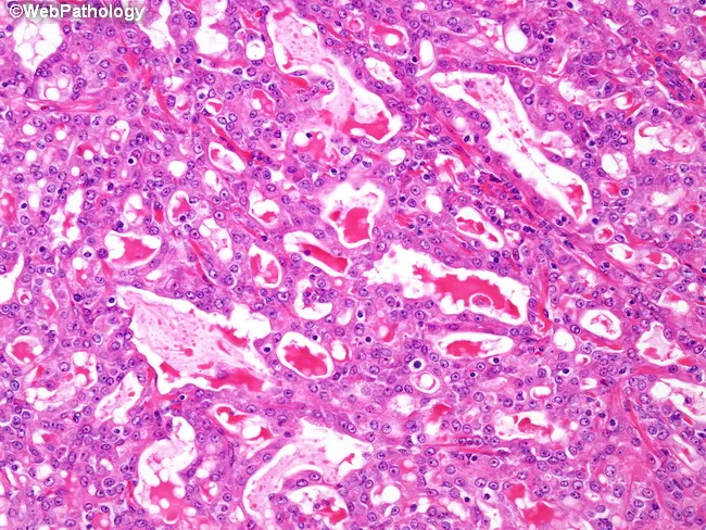 Secretory Carcinoma of Breast : Differential Diagnosis