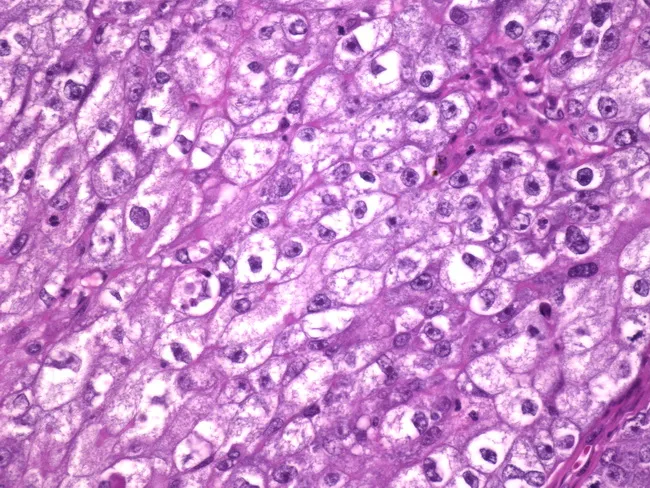 Secretory Carcinoma of Breast : Prognosis