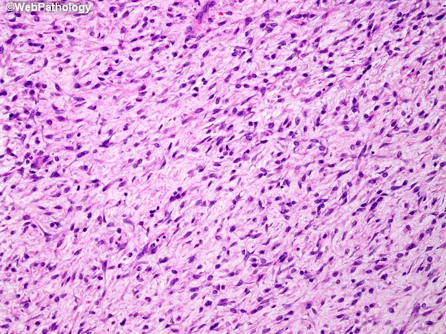 Spindle Cell Carcinoma : Fibrosarcoma-like