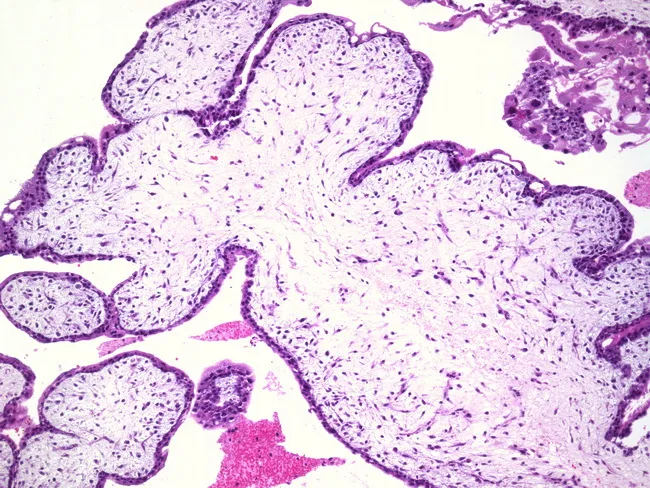 Complete Hydatidiform Mole : Myxoid stroma