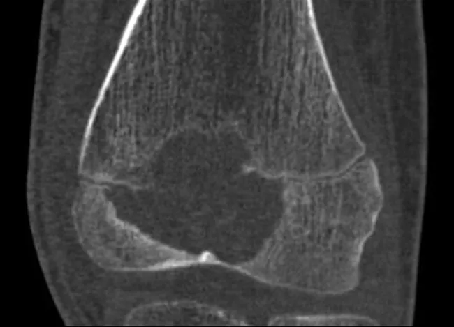 Chondroblastoma