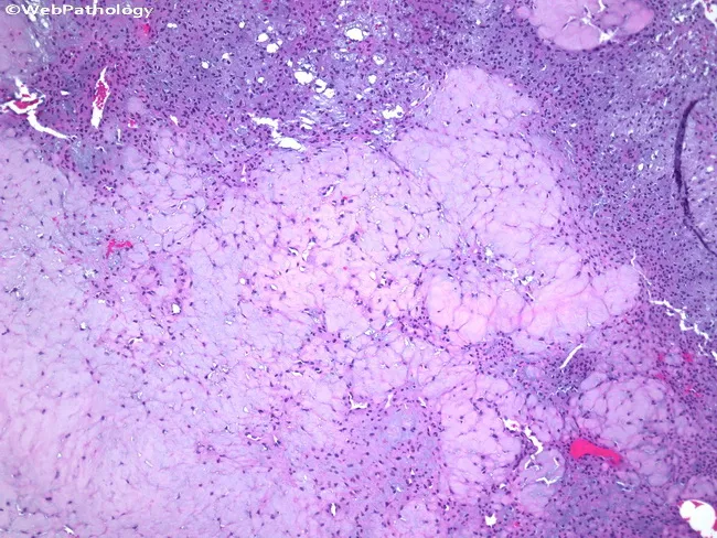 Chondromyxoid Fibroma