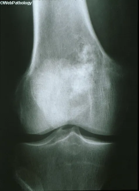 Chondrosarcoma X Ray Findings