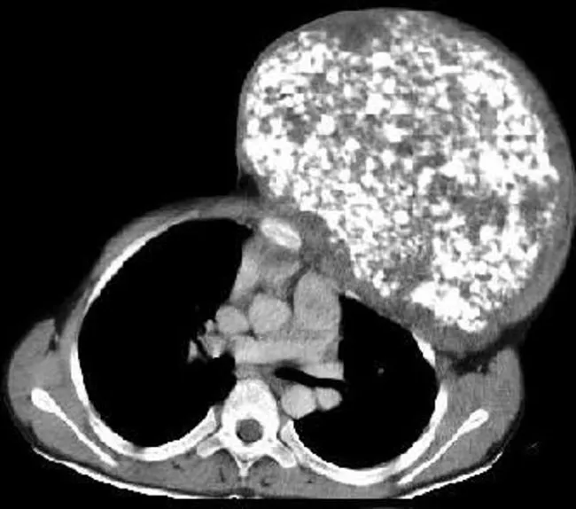 Chondrosarcoma : Chest Wall