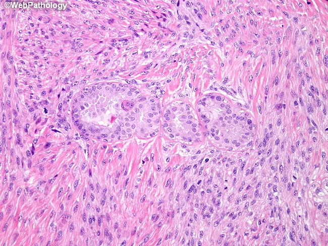 Spindle Cell Carcinoma