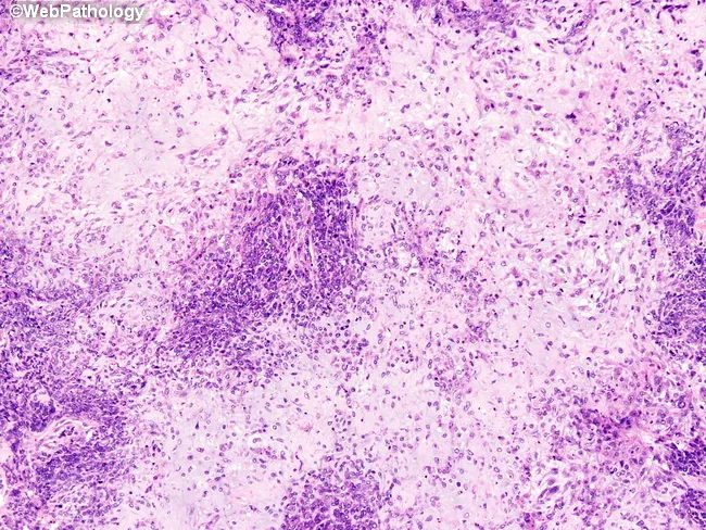 Heterologous Metaplastic Carcinoma
