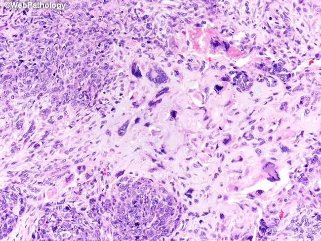 Heterologous Metaplastic Carcinoma