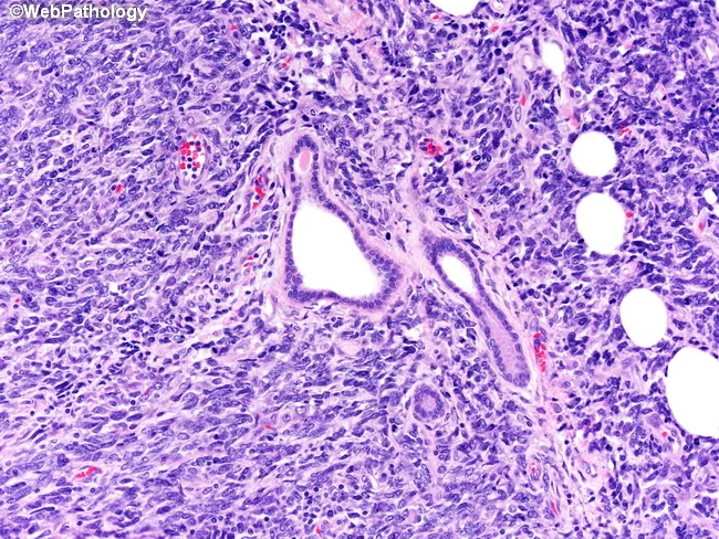 Heterologous Metaplastic Carcinoma : Prognosis