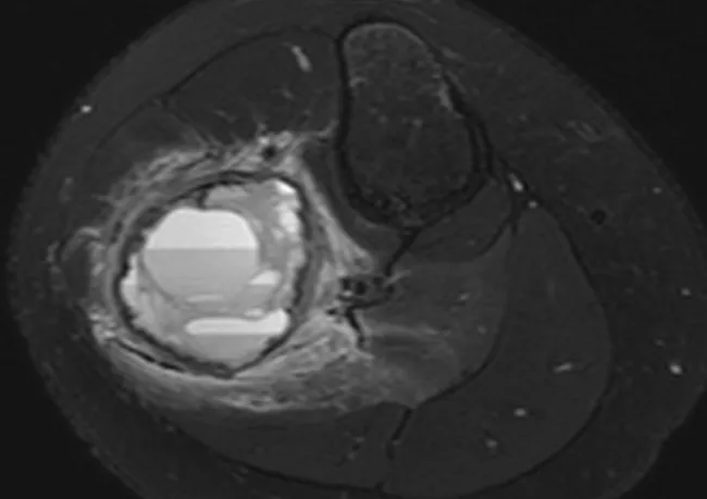 Aneurysmal Bone Cyst : Imaging - Case 1