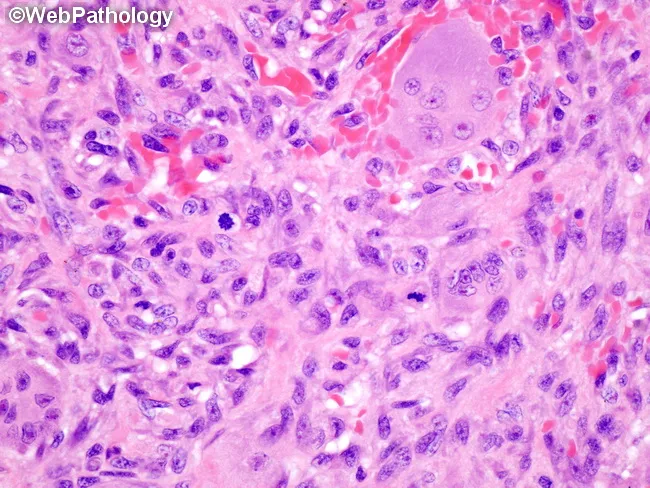 Aneurysmal Bone Cyst : Morphology