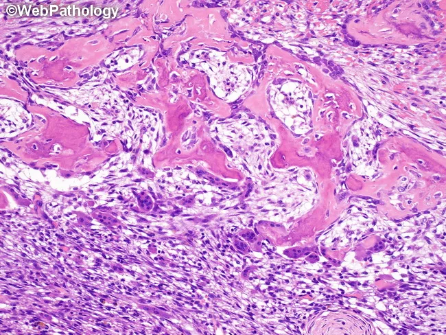 Aneurysmal Bone Cyst : Morphology