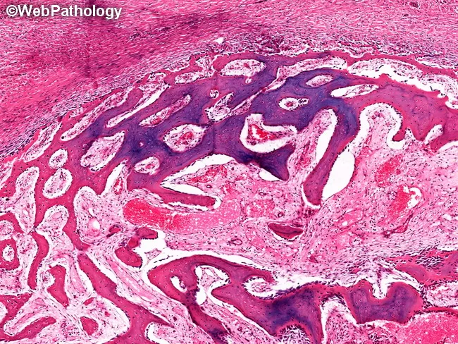 aneurysmal-bone-cyst-morphology