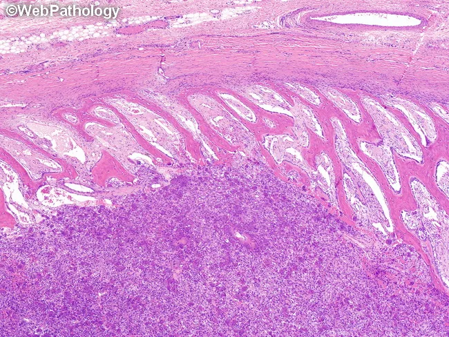 Aneurysmal Bone Cyst : Morphology