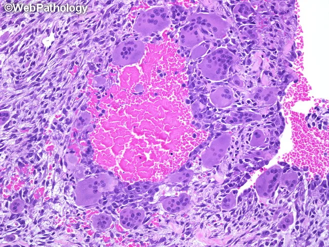 Aneurysmal Bone Cyst : Morphology