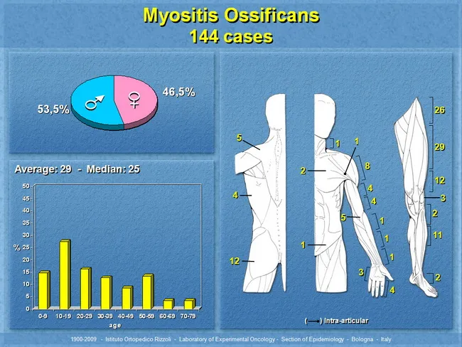 Myositis Ossificans - Clinical
