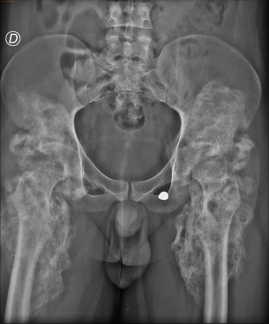 Myositis Ossificans - Imaging