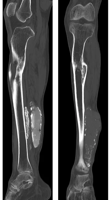 Myositis Ossificans - Imaging