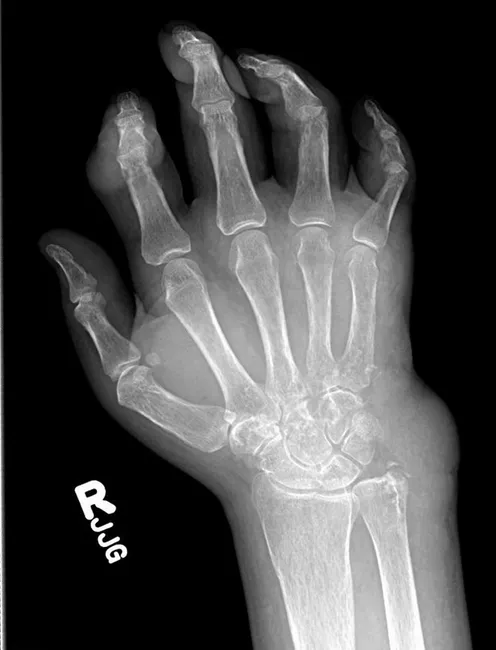 Gout : Radiographic Features