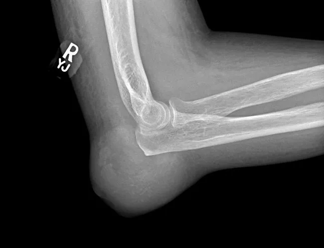 Gout : Radiographic Features