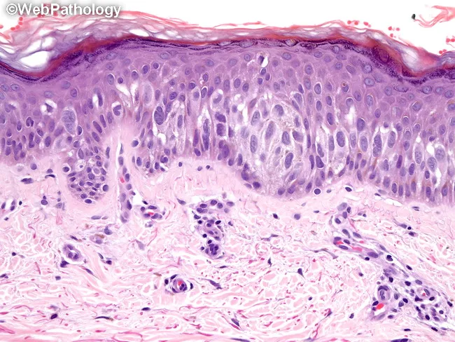 Melanoma : Clark Level 1
