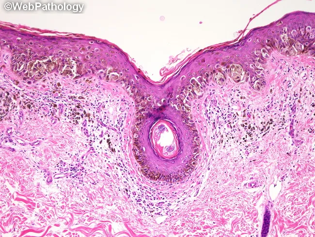 superficial spreading melanoma pathology outlines