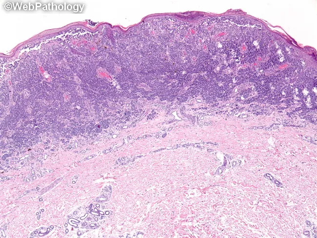 Nevoid Melanoma