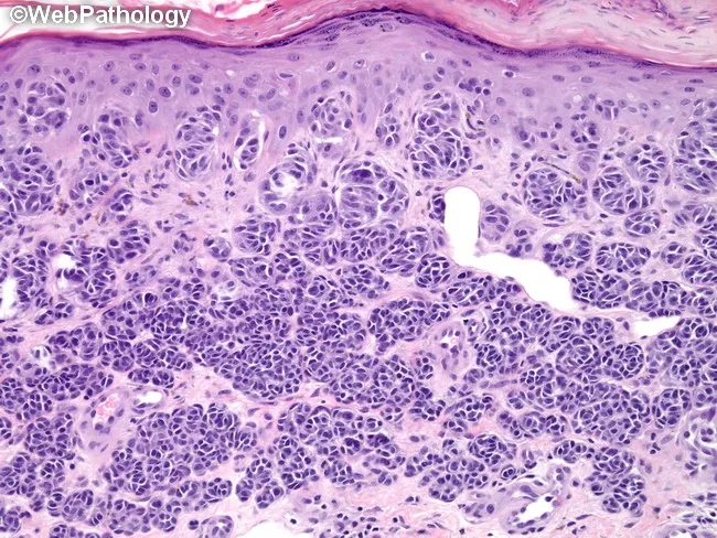 Benign Compound Nevus Pathology Outlines