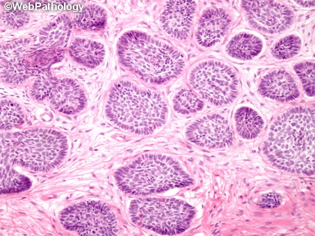 Trichoepithelioma vs Basal Cell Carcinoma