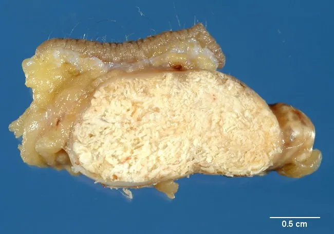 pilomatrixoma-gross-pathology