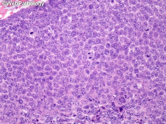 Pilomatrixoma Histology