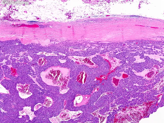 Eccrine Spiradenoma A Rare Case Of Eccrine Spiradenoma—treatment And