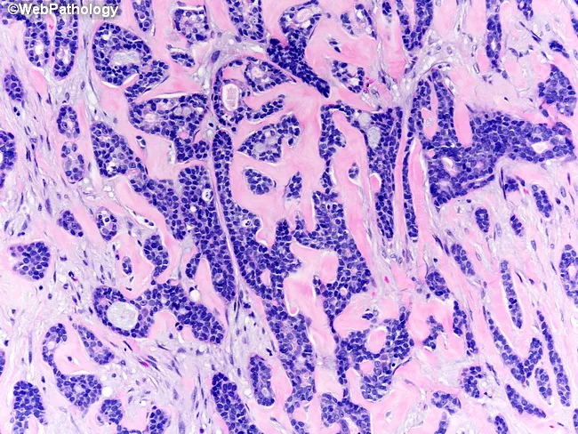 Adenoid Cystic Carcinoma of Breast