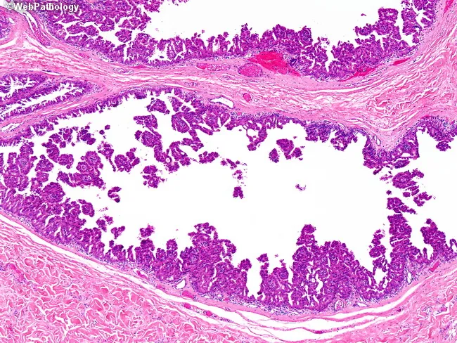 apocrine-cystadenoma