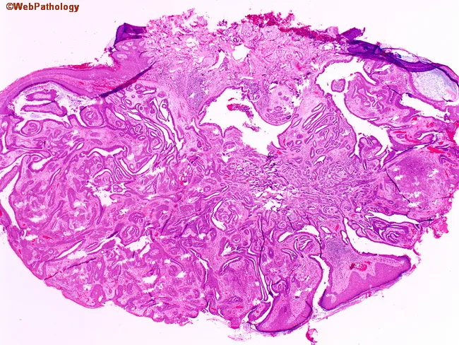 Syringocystadenoma Papilliferum