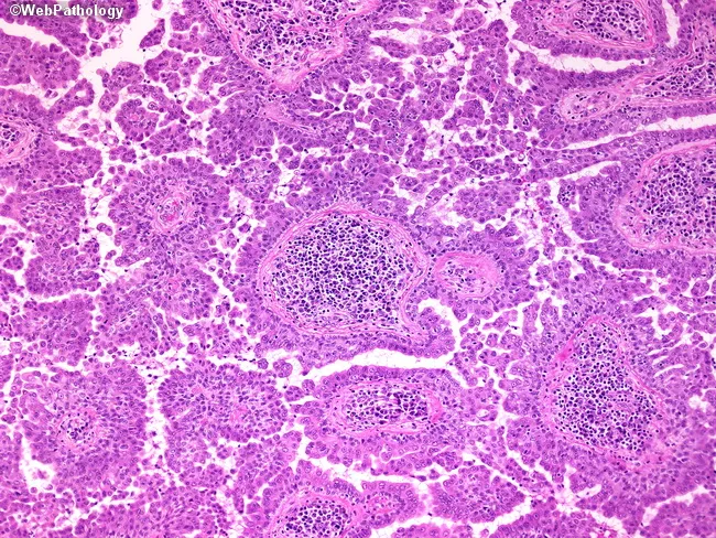 Syringocystadenoma Papilliferum
