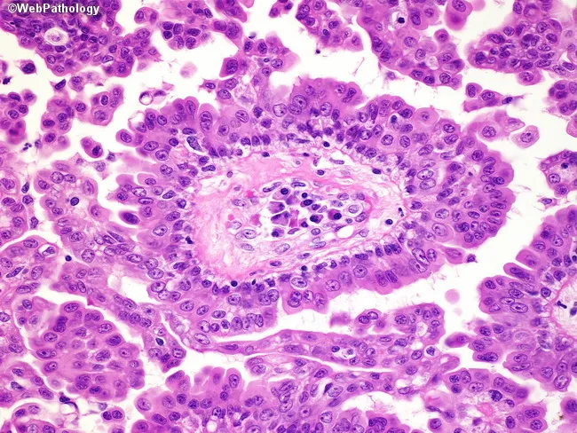 Syringocystadenoma Papilliferum
