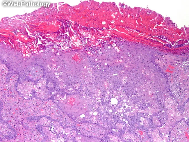 Sebaceous Carcinoma