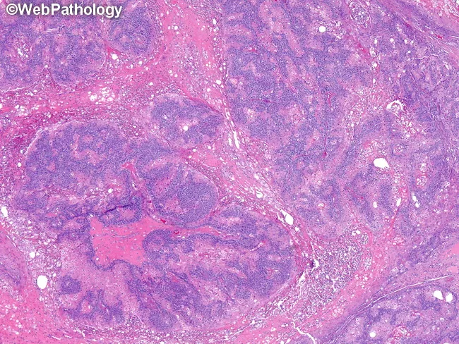 Sebaceous Carcinoma
