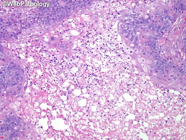 Sebaceous Carcinoma