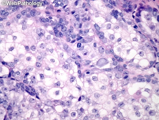 Sebaceous Carcinoma